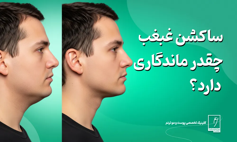 ساکشن غبغب چقدر ماندگاری دارد؟