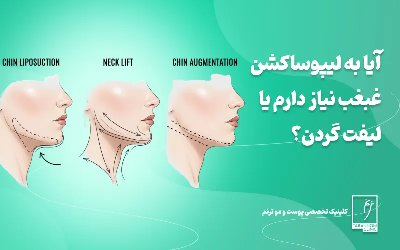 آیا به لیپوساکشن غبغب نیاز دارم یا لیفت گردن؟