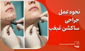 نحوه عمل لیپوساکشن غبغب: مراحل، روش ها و مراقبت ها