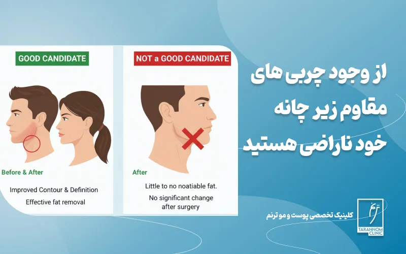 از وجود چربی های مقاوم زیر چانه خود ناراضی هستید
