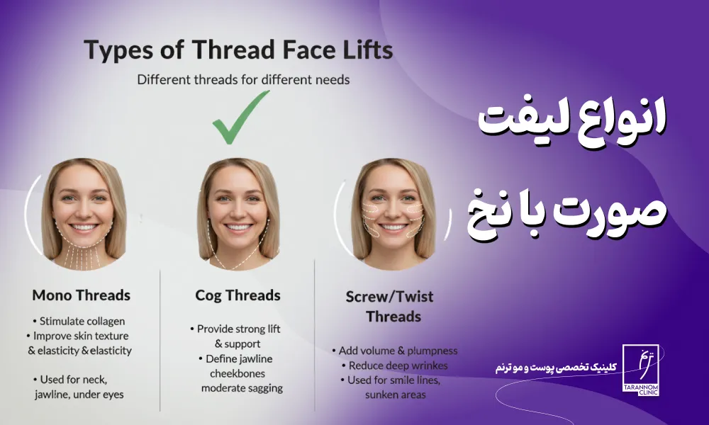 انواع لیفت با نخ